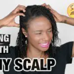 why does jamaican black castor oil cause itchy scalp
